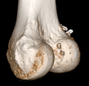 ACL CT 大腿骨２.jpg