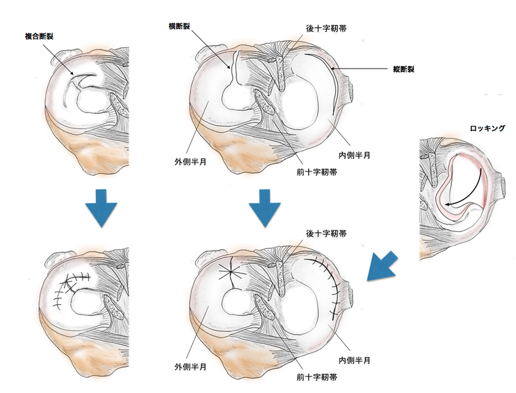 半月損傷の治療 | Knee, Arthroscopy and Sports Medicine LABORATORY 